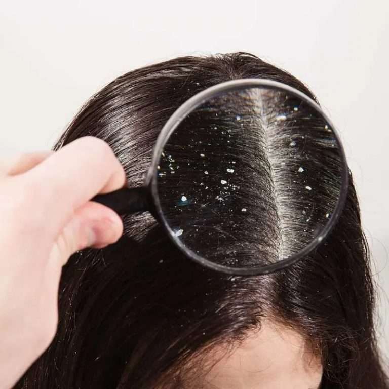 Best Dandruff Treatment in Lahore Pakistan, best dry skin specialist in Pakistan