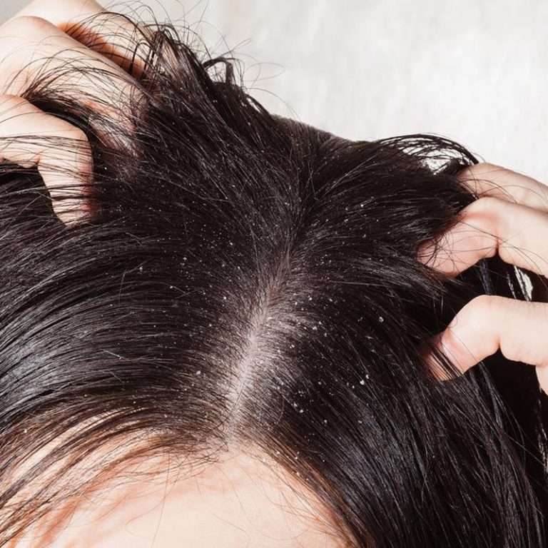 Poor Hygiene Causes Dandruff