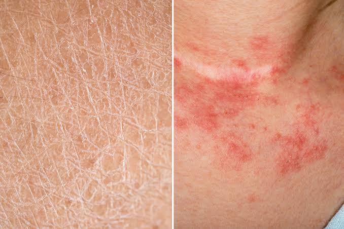 Dermatologist assessing eczema affected skin