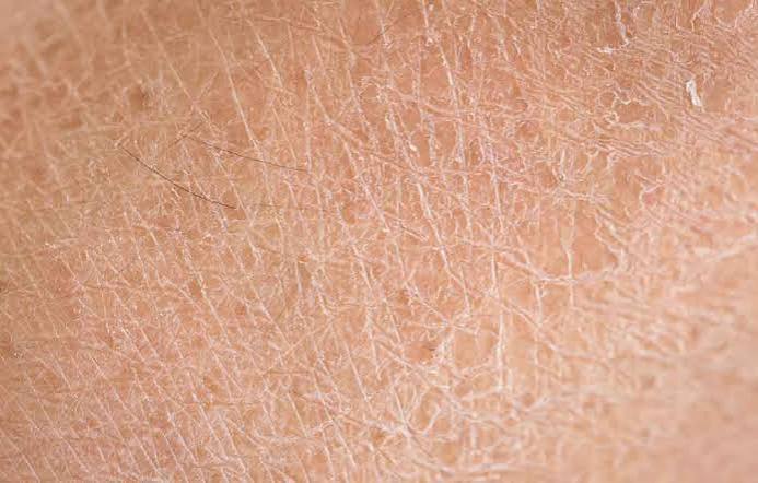 Ichthyosis