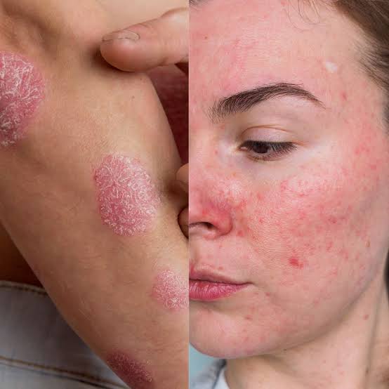 Eczema treatment at Institute Cosmetique Lahore
