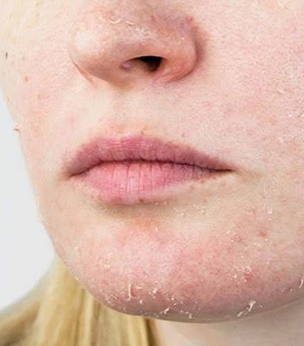 Dry Skin